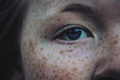 face-freckles