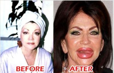 Jackie Stallone Before - After