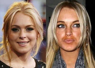 Lindsay-Lohan-before-and-after